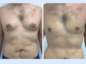 Gynecomastia in Dubai Explained: From Hormonal Imbalances to Precision-Based Surgical Correction