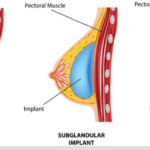 Breast Implants in Ludhiana | Safe Cosmetic Surgery