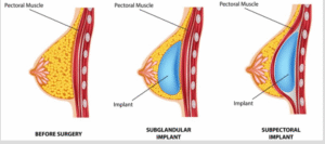 Breast Implants in Ludhiana | Safe Cosmetic Surgery