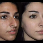 Nose Deviated Septum Surgery in Dubai Using ENT Standards