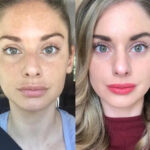 Radiofrequency (RF) Microneedling in Dubai for Premium Skin Rejuvenation