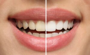 Wisdom Tooth Infections: How to Spot the Early Warning Signs