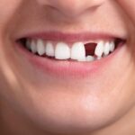 Modern Solutions to Restore a Missing Tooth and Regain Confidence