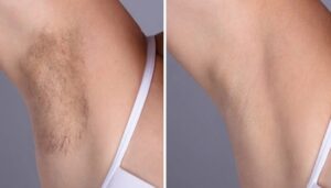 Electrolysis Laser hair removal treatment in dubai: Tips for First-Time Clients