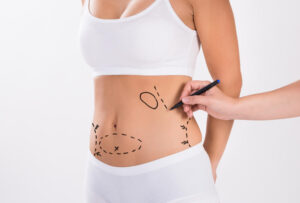 Liposuction in Dubai: A Leading Destination for Body Contouring