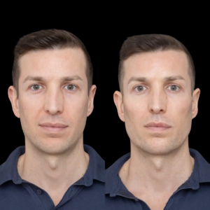 Are Jawline Fillers Treatments in Dubai FDA Approved?