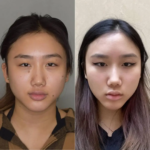 Best Buccal fat removal Surgeon in Dubai Step by Step