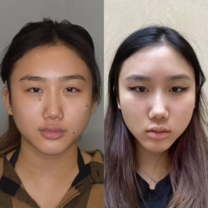 Best Buccal fat removal Surgeon in Dubai Step by Step