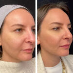 Best Aesthetic Clinic in Dubai for Mesotherapy and Skin Nourishment