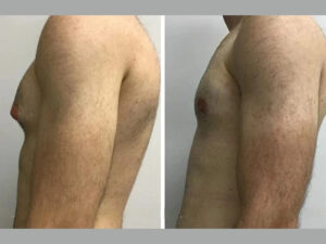 Best Gynecomastia Surgeons in Dubai Offering Personalized Care