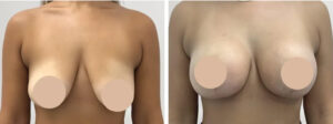 Best Breast Lift Surgeons in Dubai for Natural Results Advanced Expertise