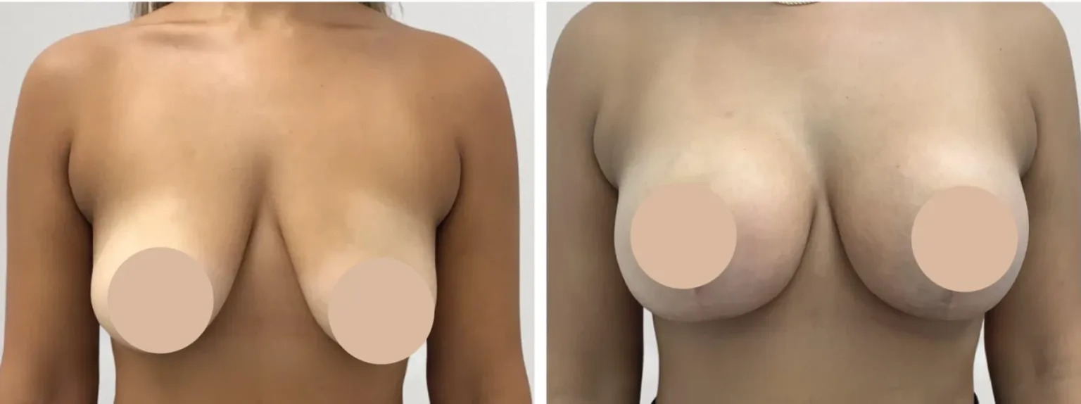H1 Breast Lift 1 1