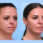 Best Plastic Surgeons in Dubai Thread Lift Treatments Delivering Natural Youthful Facial Results