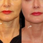 Best Plastic Surgeon in Dubai Explains Sculptra Fillers Performance Metrics