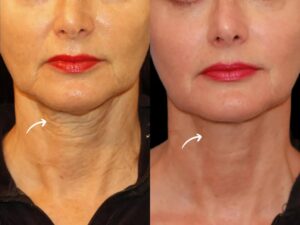 Best Plastic Surgeon in Dubai Explains Sculptra Fillers Performance Metrics