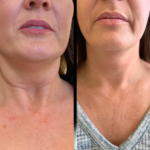 Best Plastic Surgeon in Dubai for Refined Profhilo Outcomes