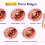 What Can a Colonoscopy Detect? Conditions, Polyps, and Cancer