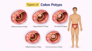 What Can a Colonoscopy Detect? Conditions, Polyps, and Cancer