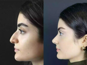 Rhinoplasty in Dubai: Professional Care for Nose Correction