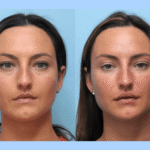 Achieve Youthful Results with Thread Lift in Dubai