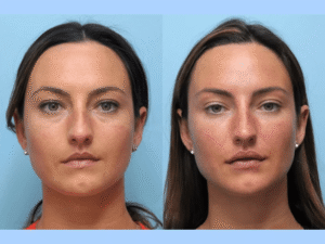 Achieve Youthful Results with Thread Lift in Dubai