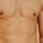 شفط الدهون في جدة للحصول على قوام أكثر تناسقًا