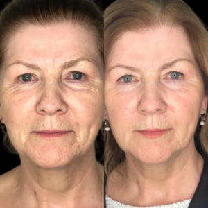 Profhilo Expertise from Best Plastic Surgeons in Dubai