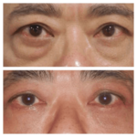 Confidence Benefits | Best Eye bag removal Surgeons in dubai