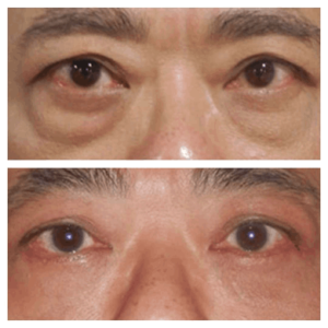 Confidence Benefits | Best Eye bag removal Surgeons in dubai