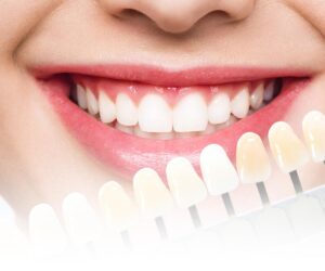 Dental Veneers Dubai for a Brighter and More Symmetrical Smile