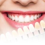 Dental Veneers Dubai for a Brighter and More Symmetrical Smile