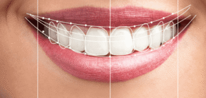 Hollywood Smile in Dubai: Get a Celebrity-Style Smile with Precision Care