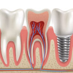 dental implants 4