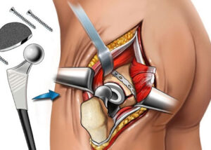 Orthopedics Clinic in Miyapur | Best Orthopedic Surgeon in Madinaguda, Nallagandla - Dr. B. Chakradhar Reddy 1 Orthopedics Clinic in Miyapur | Best Orthopedic Surgeon in Madinaguda, Nallagandla – Dr. B. Chakradhar Reddy