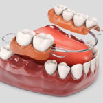 dentures 2
