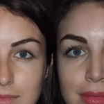 rhinoplasty in dubai 1 1