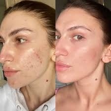 Cost and Treatment Duration of Skinpen Microneedling in Altrincham