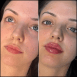 H5 lip fillers 1