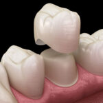 dental crowns