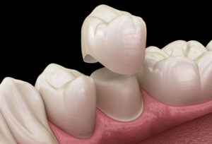 Apollo Dental Clinic in Chandanagar, Kukatpally, Madinaguda and Hyderabad - Dr. John’s Dentistry 1 Apollo Dental Clinic in Chandanagar, Kukatpally, Madinaguda and Hyderabad – Dr. John’s Dentistry