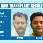Top Celebrity Hair Transplant Doctor in Delhi, India: Clinical Expertise and Aesthetic Precision