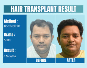 Top Celebrity Hair Transplant Doctor in Delhi, India: Clinical Expertise and Aesthetic Precision