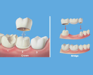 Confydentz® Dental Clinic in Guntur | Best Dental Hospital in Guntur - Dr. Ranjit Kumar Peravali 1 Confydentz® Dental Clinic in Guntur | Best Dental Hospital in Guntur – Dr. Ranjit Kumar Peravali