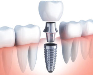 Mithra Dental Hospital in Narasaraopet | Best Dental Clinic in Narasaraopet | Dentist in Narasaraopet – Dr.Sai Ramesh.K