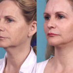Chemical Peel Treatment in dubai Even Complexion
