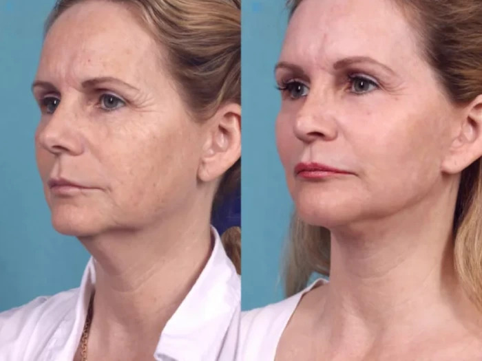 H2 Chemical Peel 4