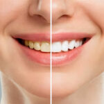 teeth whitening 1