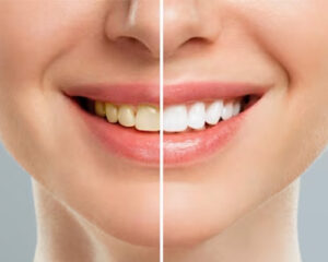 RV Dental Clinic in Nallagandla | Best Dental Hospital in Nallagandla | Dentist in Hyderabad - Dr. Hima R 1 RV Dental Clinic in Nallagandla | Best Dental Hospital in Nallagandla | Dentist in Hyderabad – Dr. Hima R