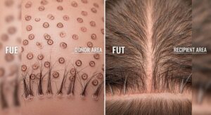 FUE and FUT Hair Transplant Modern Techniques for Natural, Lasting Results
