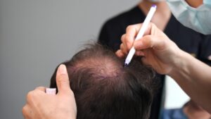 Can Hair Transplant in Dubai Transform Sparse Strands into Volume?
